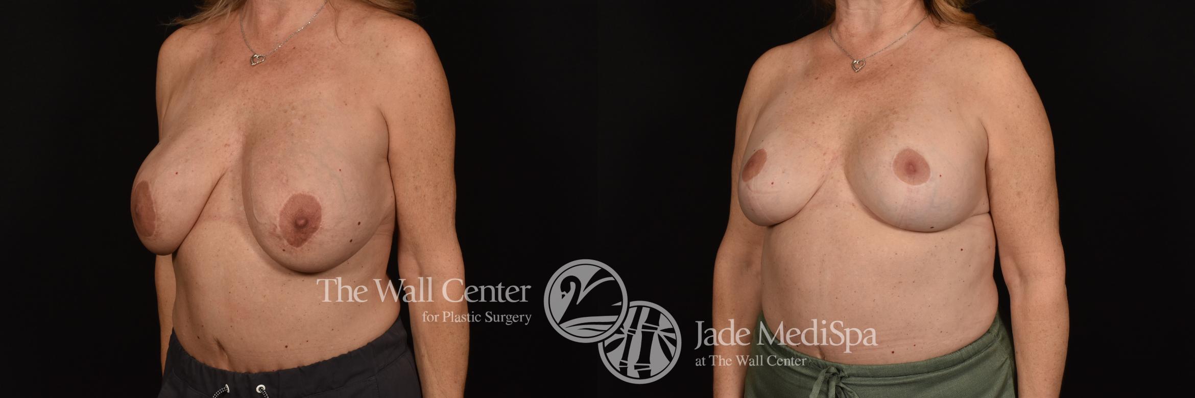 Before & After Breast Augmentation with Lift Case 1180 Left Oblique View in Shreveport, LA