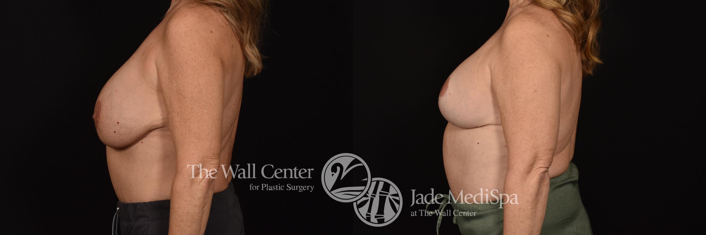 Before & After Breast Augmentation with Lift Case 1180 Left Side View in Shreveport, LA