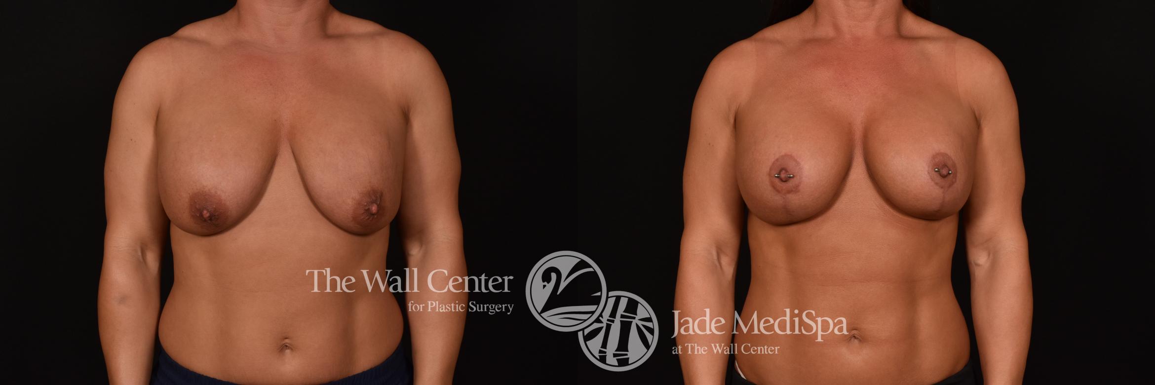 Before & After Breast Implant Exchange Case 1182 Front View in Shreveport, LA
