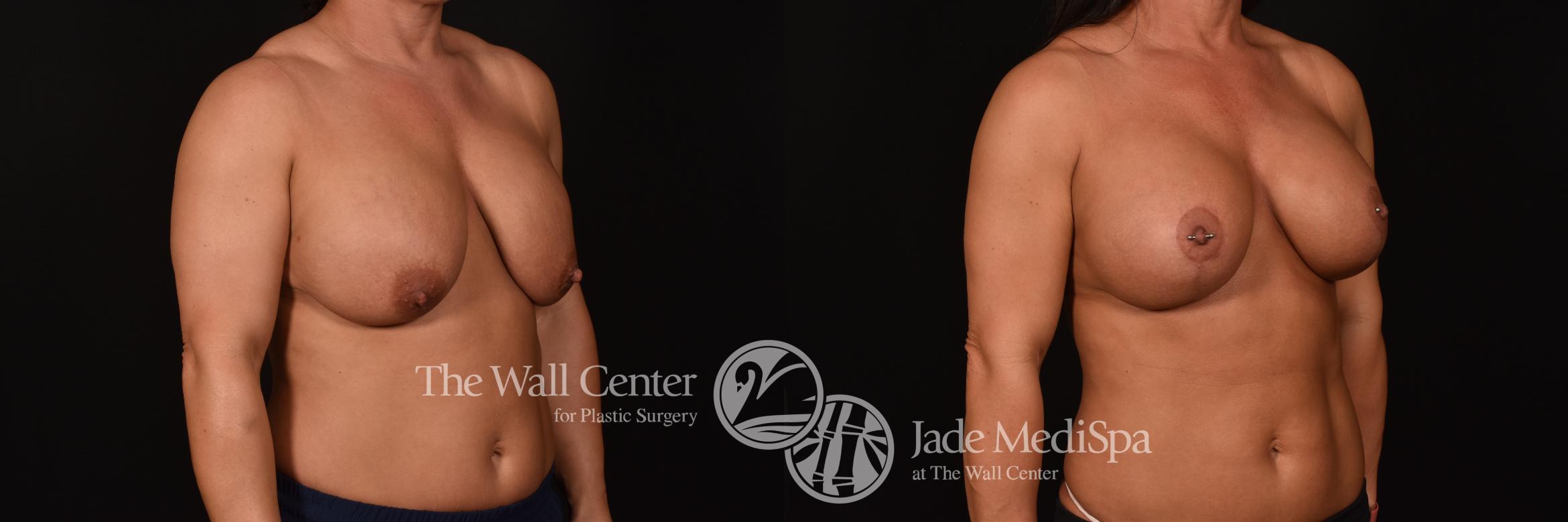 Before & After Breast Implant Exchange Case 1182 Right Oblique View in Shreveport, LA