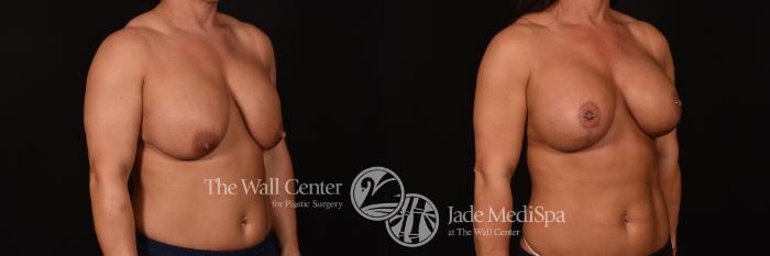 Before & After Breast Implant Exchange Case 1182 Right Oblique View in Shreveport, LA