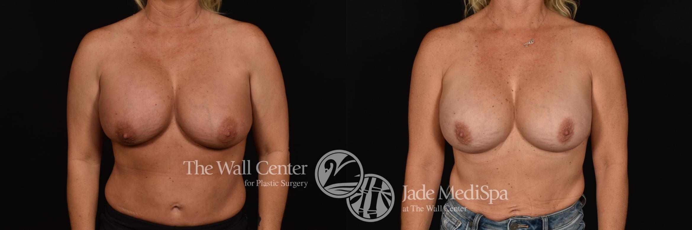 Before & After Breast Implant Exchange Case 1187 Front View in Shreveport, LA