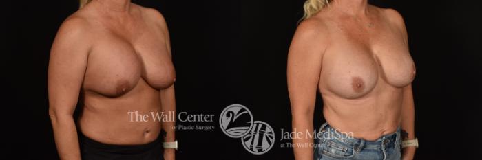 Before & After Breast Implant Exchange Case 1187 Right Oblique View in Shreveport, LA