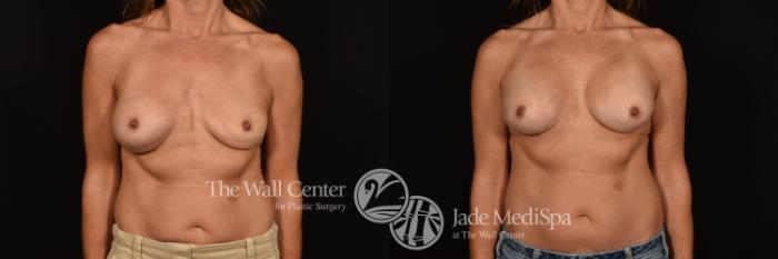 Before & After Breast Implant Exchange Case 1191 Front View in Shreveport, LA