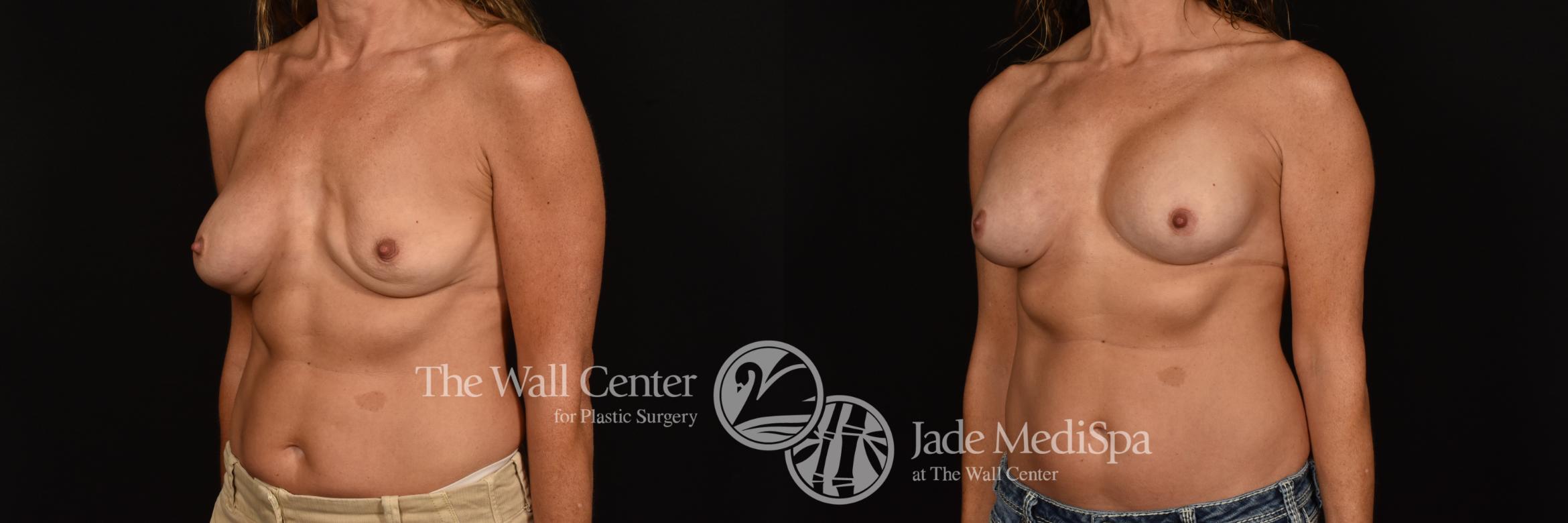 Before & After Breast Implant Exchange Case 1191 Left Oblique View in Shreveport, LA