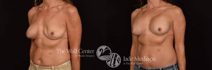 Before & After Breast Implant Exchange Case 1191 Left Oblique View in Shreveport, LA
