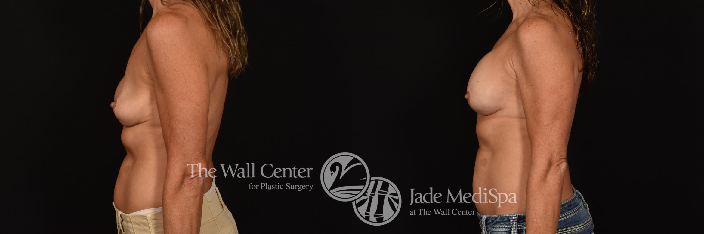 Before & After Breast Implant Exchange Case 1191 Left Side View in Shreveport, LA