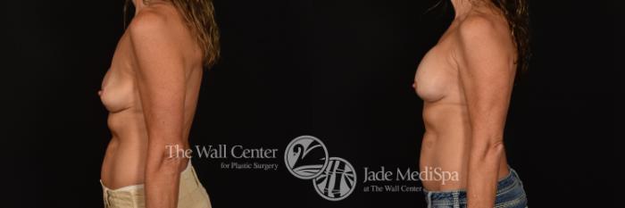 Before & After Breast Implant Exchange Case 1191 Left Side View in Shreveport, LA