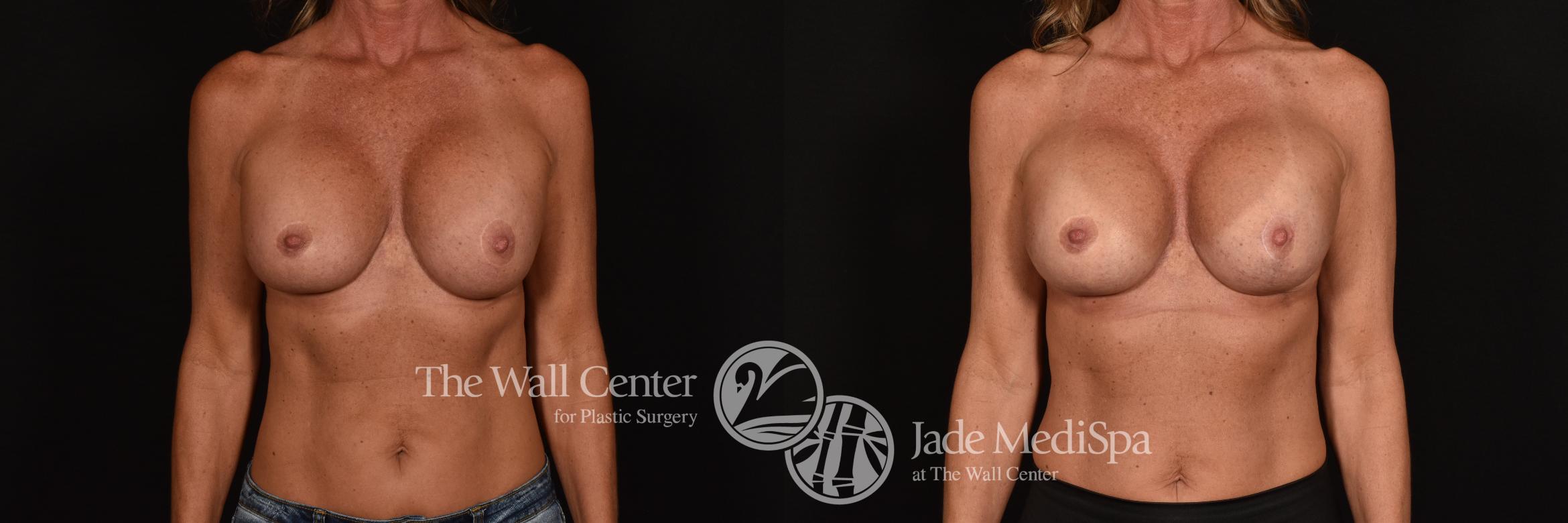 Before & After Breast Implant Exchange Case 1202 Front View in Shreveport, LA