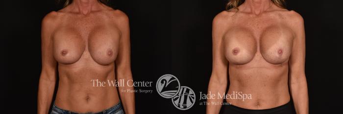 Before & After Breast Implant Exchange Case 1202 Front View in Shreveport, LA