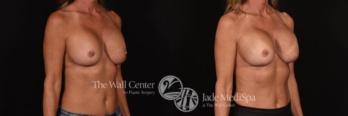 Before & After Breast Implant Exchange Case 1202 Right Oblique View in Shreveport, LA