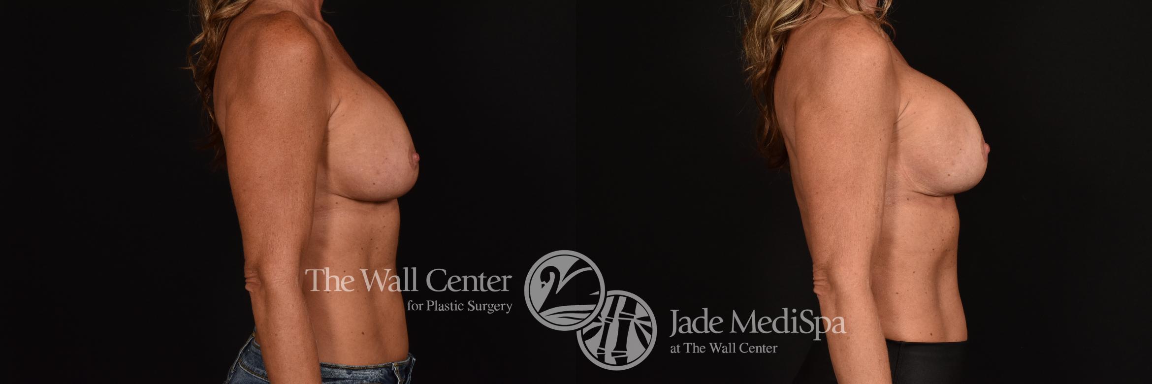 Before & After Breast Implant Exchange Case 1202 Right Side View in Shreveport, LA