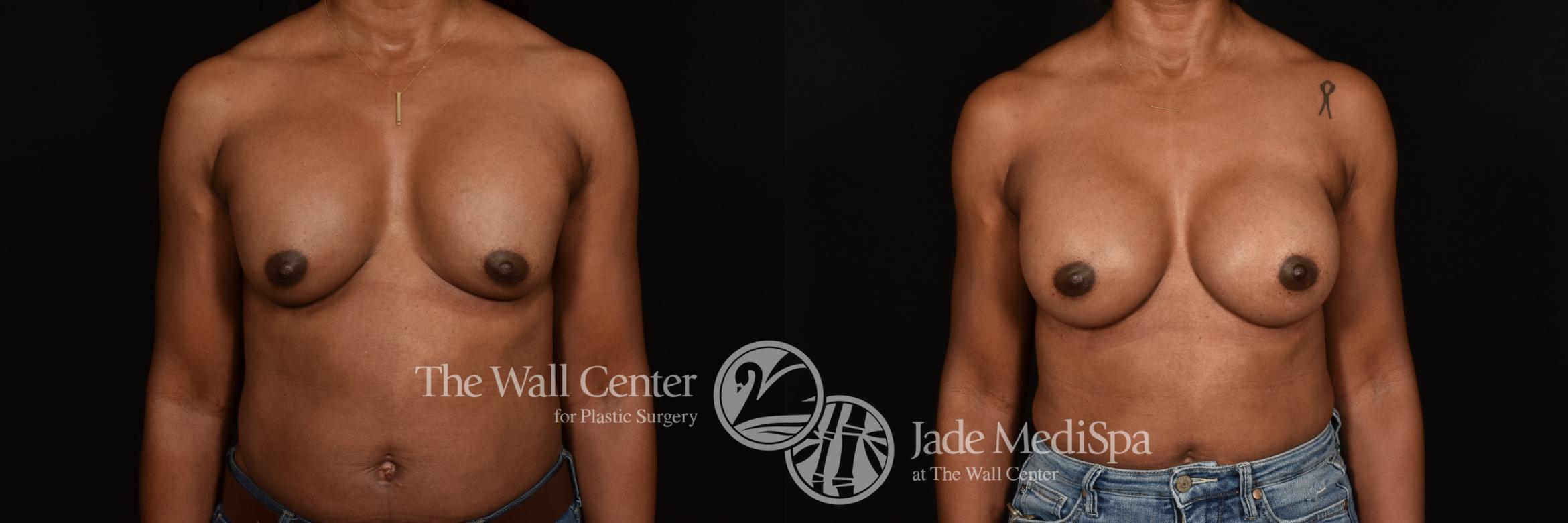 Before & After Breast Implant Exchange Case 1207 Front View in Shreveport, LA