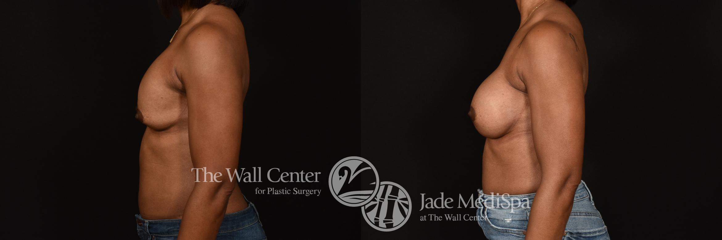 Before & After Breast Implant Exchange Case 1207 Left Side View in Shreveport, LA