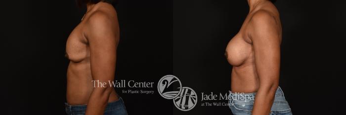 Before & After Breast Implant Exchange Case 1207 Left Side View in Shreveport, LA