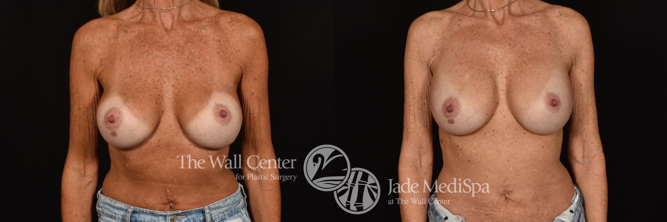 Before & After Breast Implant Exchange Case 1208 Front View in Shreveport, LA