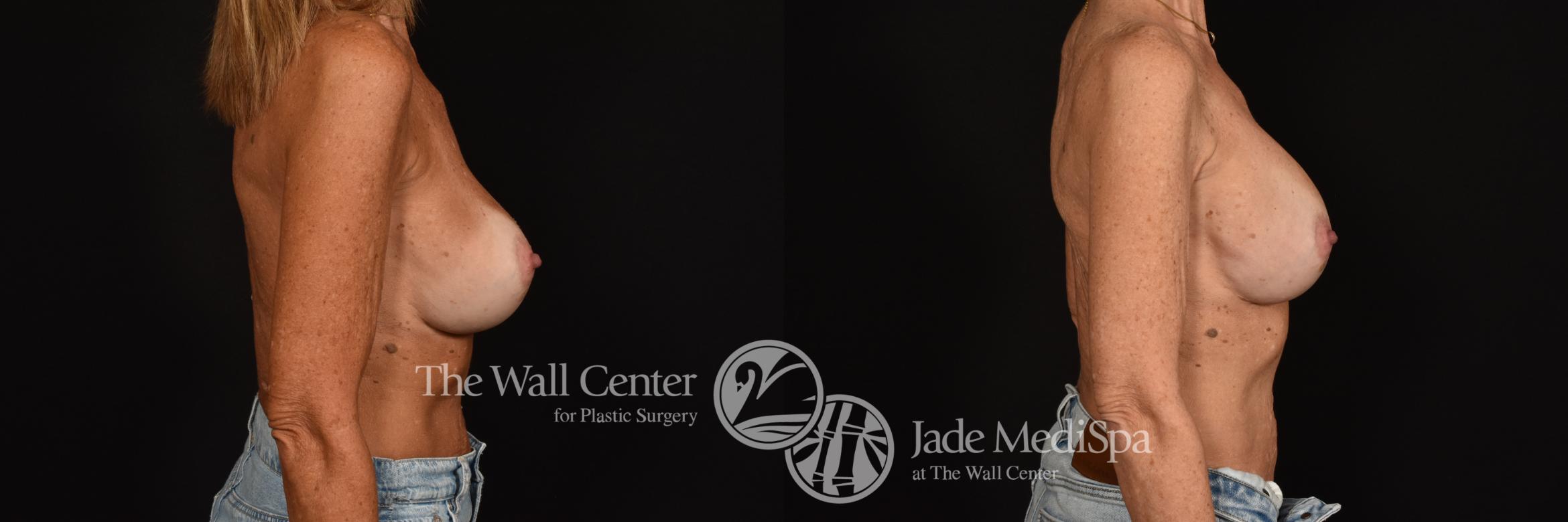 Before & After Breast Implant Exchange Case 1208 Right Side View in Shreveport, LA