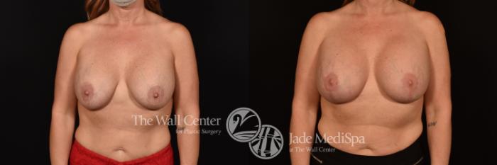 Before & After Breast Implant Exchange Case 1222 Front View in Shreveport, LA