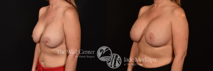 Before & After Breast Implant Exchange Case 1222 Left Oblique View in Shreveport, LA