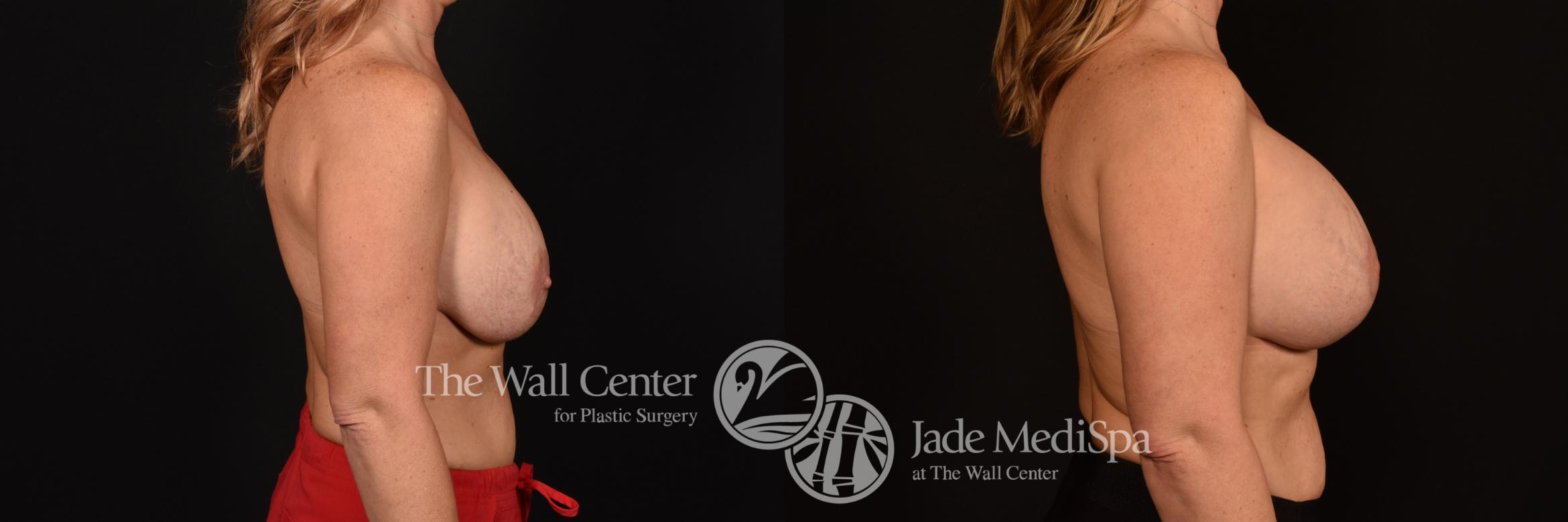 Before & After Breast Implant Exchange Case 1222 Right Side View in Shreveport, LA