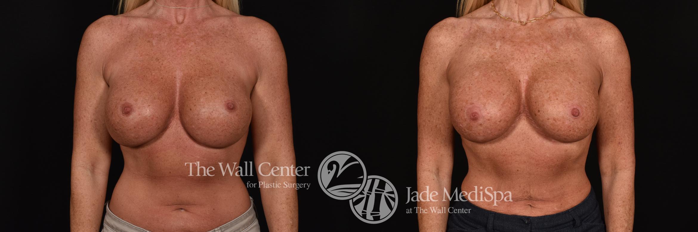 Before & After Breast Implant Exchange Case 1227 Front View in Shreveport, LA