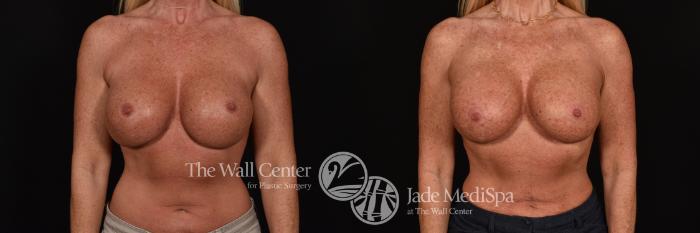 Before & After Breast Implant Exchange Case 1227 Front View in Shreveport, LA