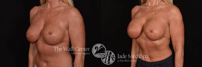 Before & After Breast Implant Exchange Case 1227 Left Oblique View in Shreveport, LA
