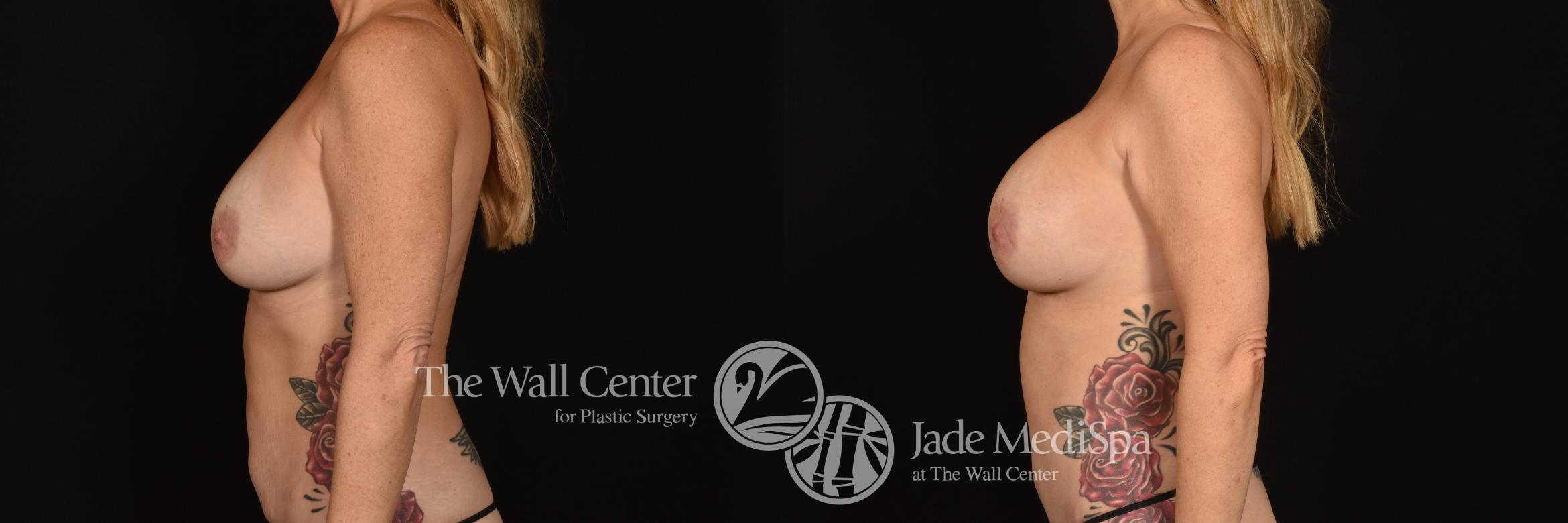 Before & After Breast Implant Exchange Case 1229 Left Side View in Shreveport, LA