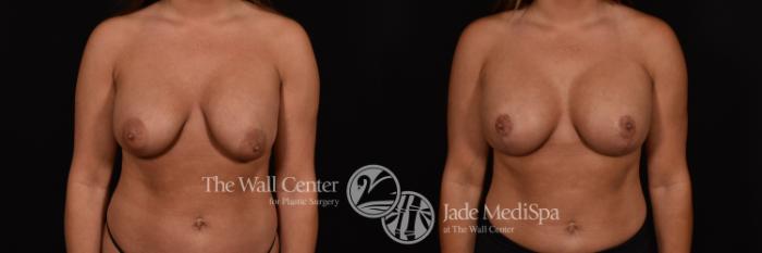 Before & After Breast Lift Case 1230 Front View in Shreveport, LA