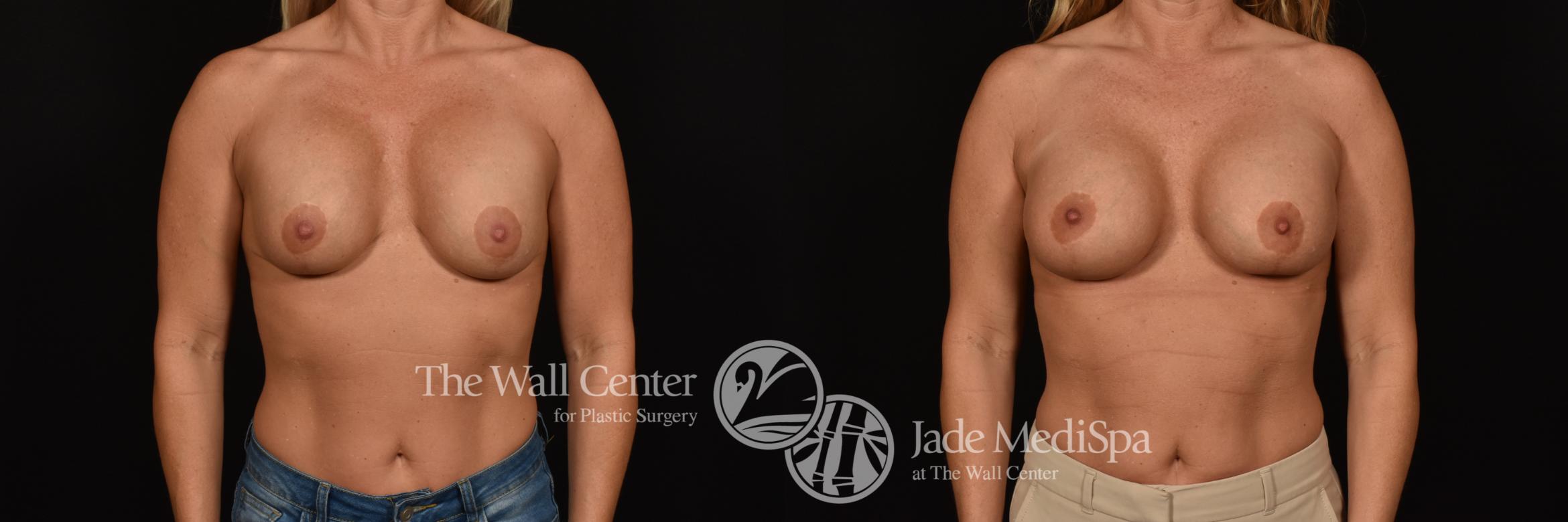 Before & After Breast Implant Exchange Case 1243 Front View in Shreveport, LA