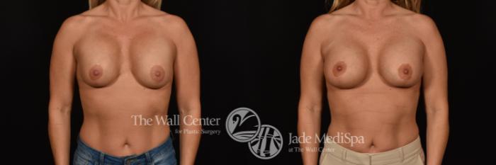 Before & After Breast Implant Exchange Case 1243 Front View in Shreveport, LA
