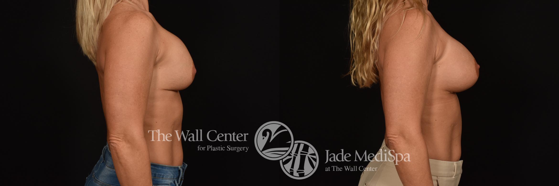 Before & After Breast Implant Exchange Case 1243 Left Side View in Shreveport, LA