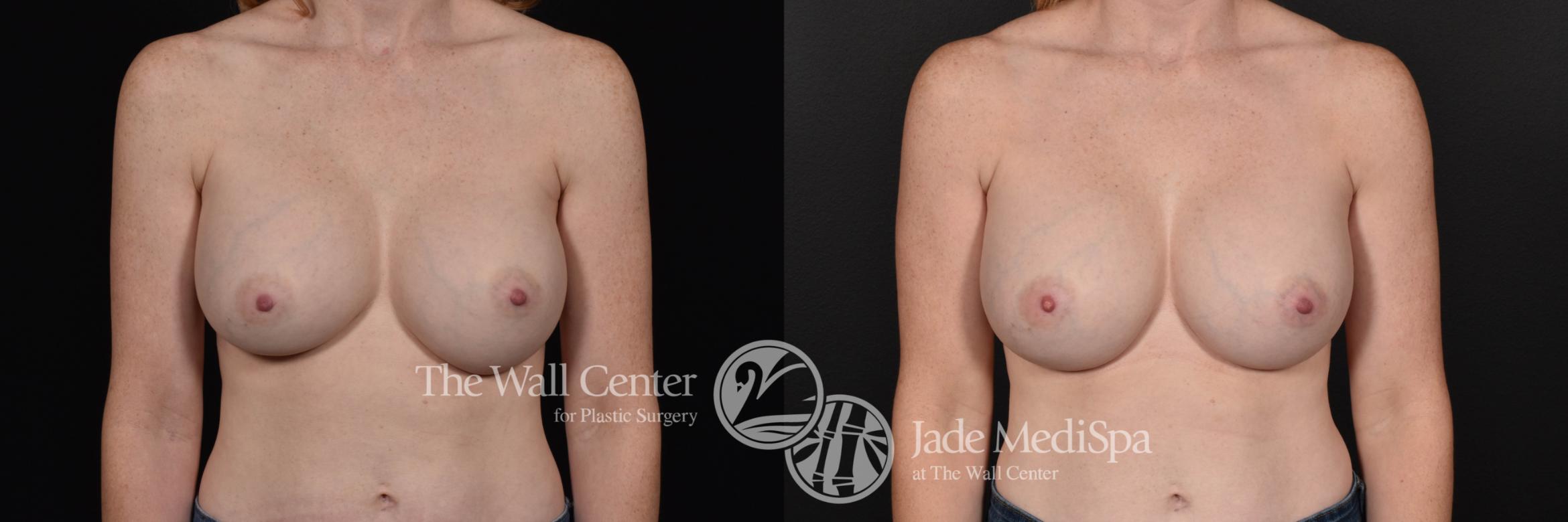 Breast Implant Exchange Front Photo, Shreveport, Louisiana, The Wall Center for Plastic Surgery, Case 859