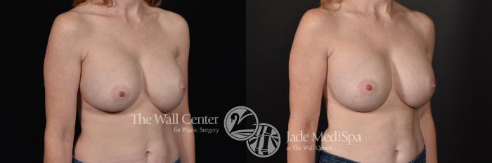 Breast Implant Exchange Right Oblique Photo, Shreveport, Louisiana, The Wall Center for Plastic Surgery, Case 859