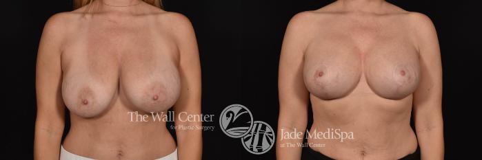 Breast Implant Exchange with Lift & SAFELipo Front Photo, Shreveport, Louisiana, The Wall Center for Plastic Surgery, Case 859