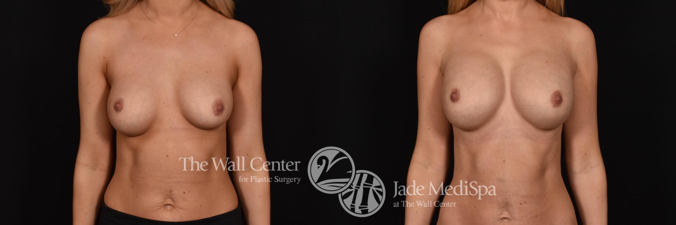 Breast Implant Exchange Front Photo, Shreveport, Louisiana, The Wall Center for Plastic Surgery, Case 861