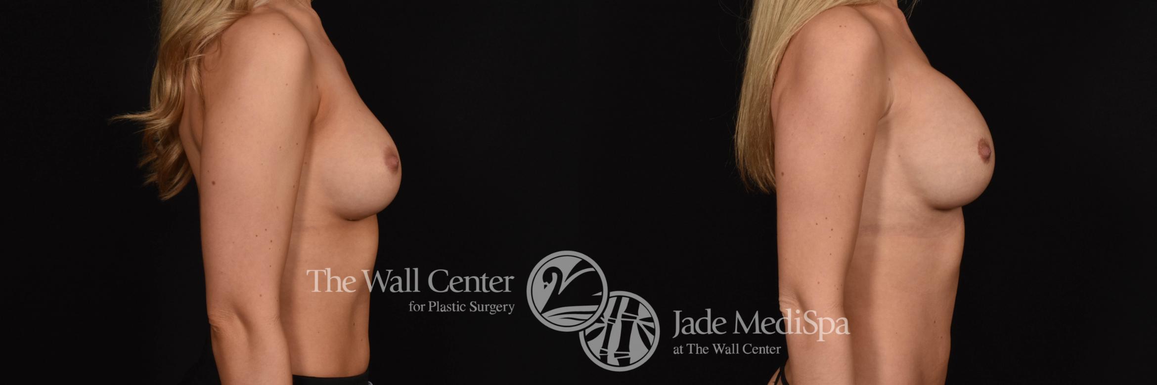 Breast Implant Exchange Right Side Photo, Shreveport, Louisiana, The Wall Center for Plastic Surgery, Case 861
