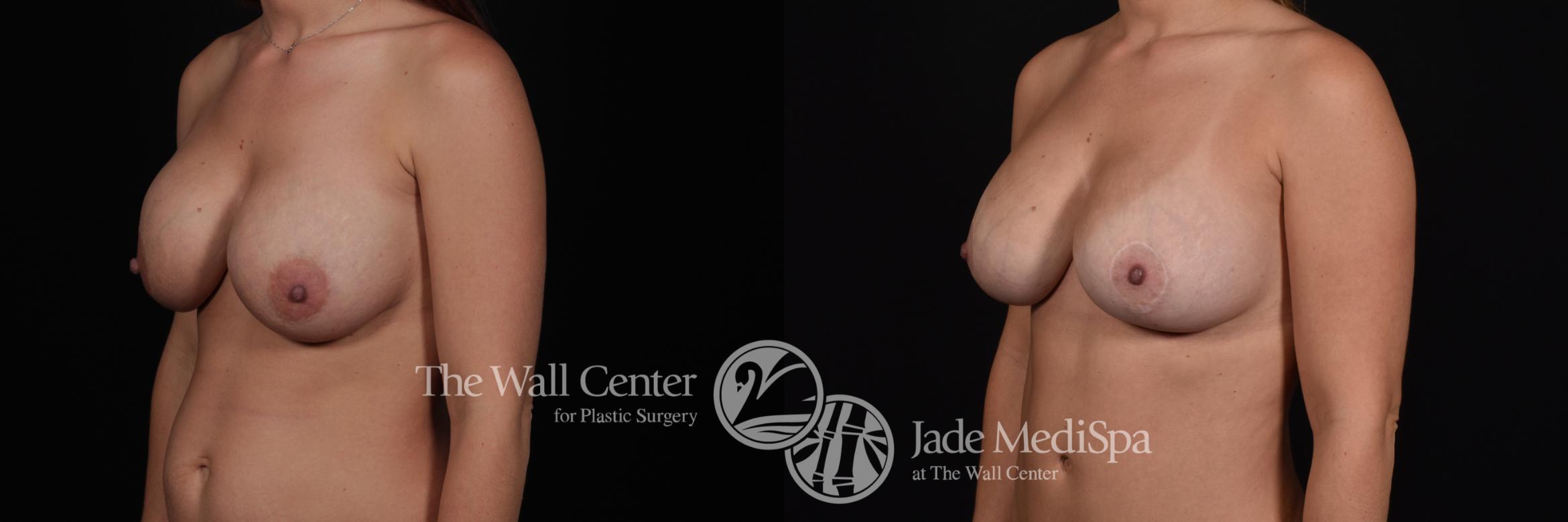 Breast Implant Exchange Front Photo, Shreveport, Louisiana, The Wall Center for Plastic Surgery, Case 863