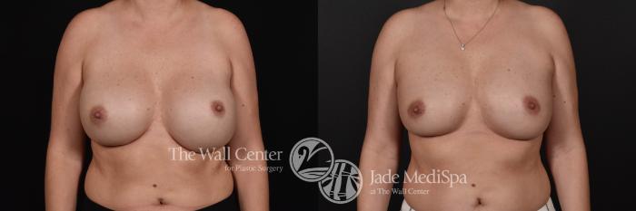 Breast Implant Exchange Front Photo, Shreveport, Louisiana, The Wall Center for Plastic Surgery, Case 865