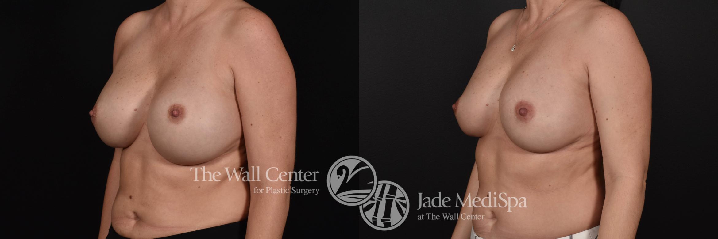 Breast Implant Exchange Left Oblique Photo, Shreveport, Louisiana, The Wall Center for Plastic Surgery, Case 865