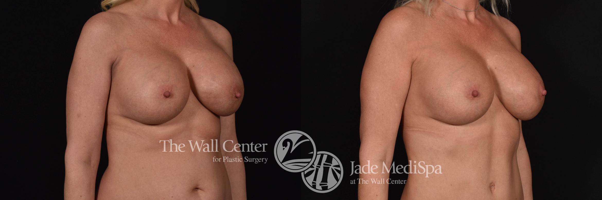 Breast Implant Exchange Right Oblique Photo, Shreveport, Louisiana, The Wall Center for Plastic Surgery, Case 866