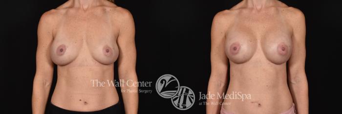 Breast Implant Exchange Front Photo, Shreveport, Louisiana, The Wall Center for Plastic Surgery, Case 868