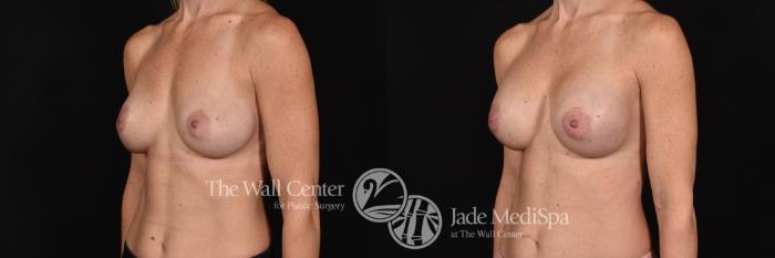Breast Implant Exchange Left Oblique Photo, Shreveport, Louisiana, The Wall Center for Plastic Surgery, Case 868