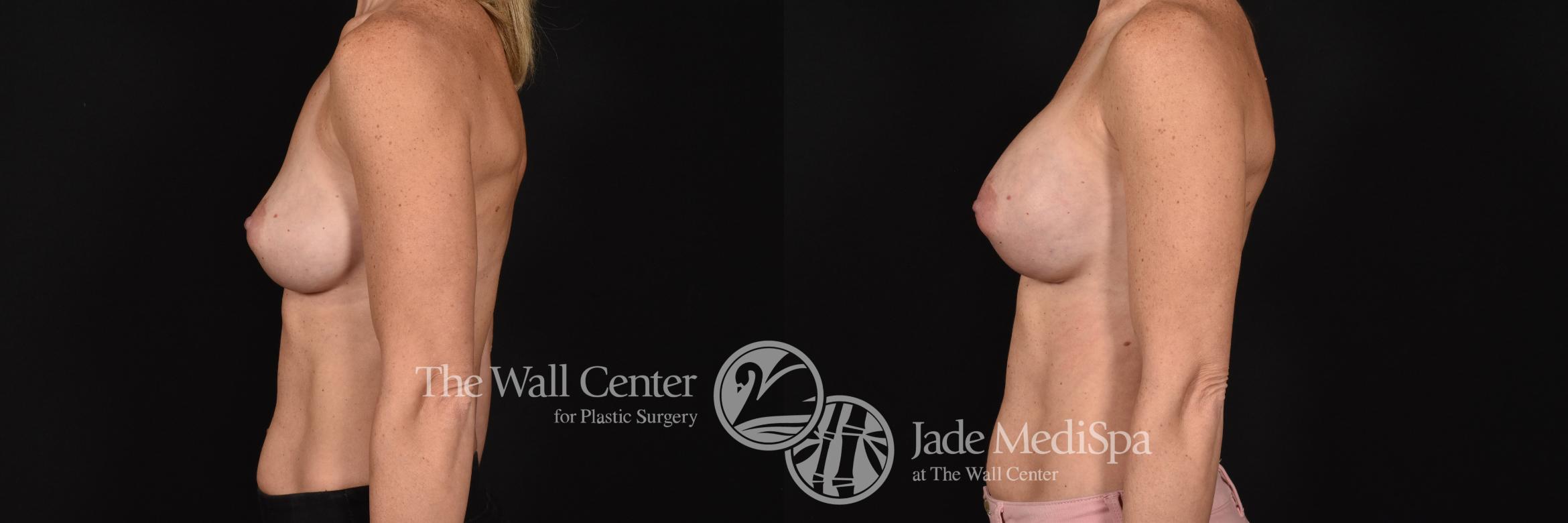 Breast Implant Exchange Left Side Photo, Shreveport, Louisiana, The Wall Center for Plastic Surgery, Case 868