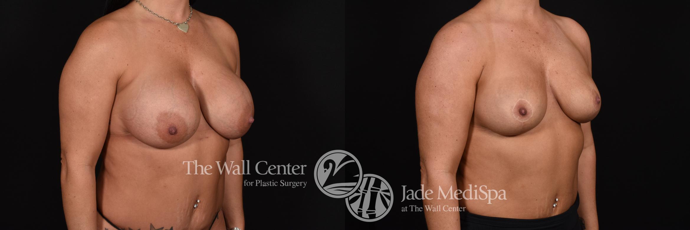 Breast Implant Exchange with Lift & SAFELipo Right Oblique Photo, Shreveport, Louisiana, The Wall Center for Plastic Surgery, Case 869