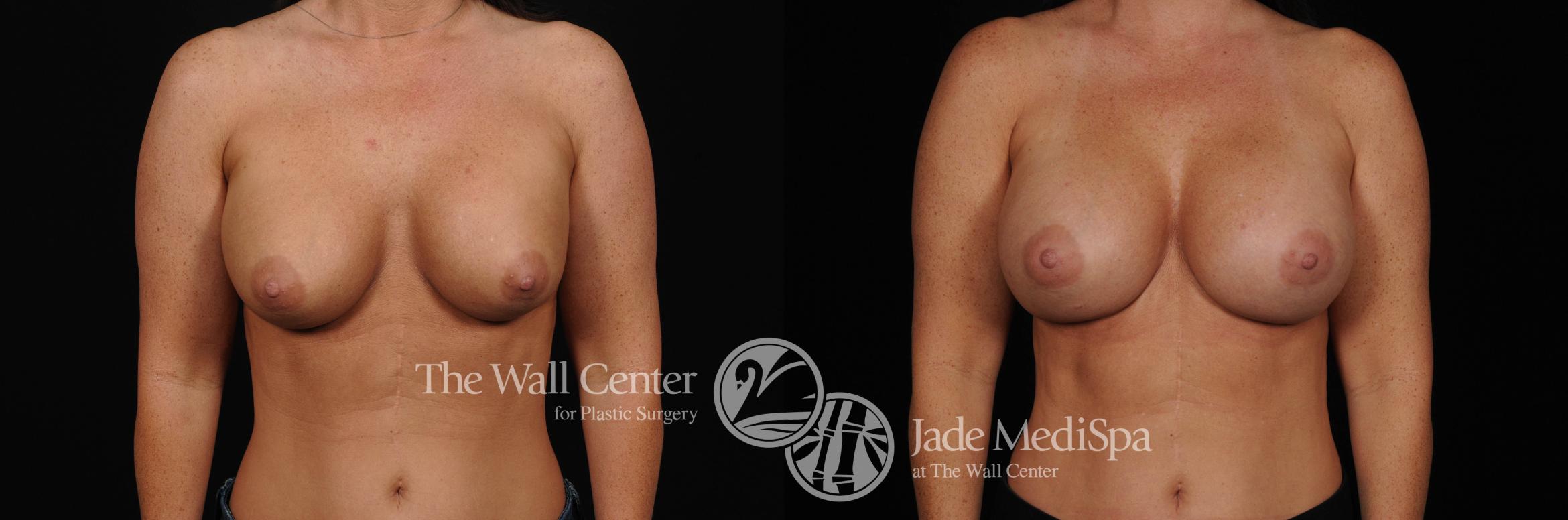 Breast Implant Exchange Front Photo, Shreveport, Louisiana, The Wall Center for Plastic Surgery, Case 870