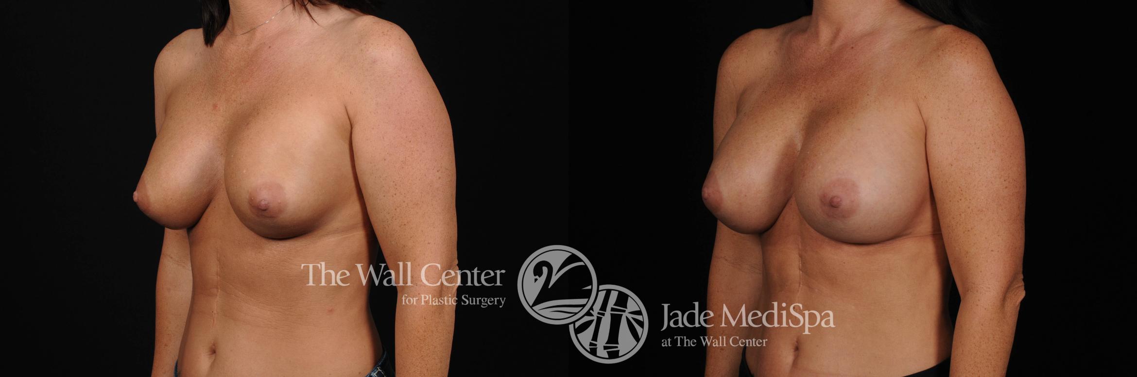 Breast Implant Exchange Left Oblique Photo, Shreveport, Louisiana, The Wall Center for Plastic Surgery, Case 870