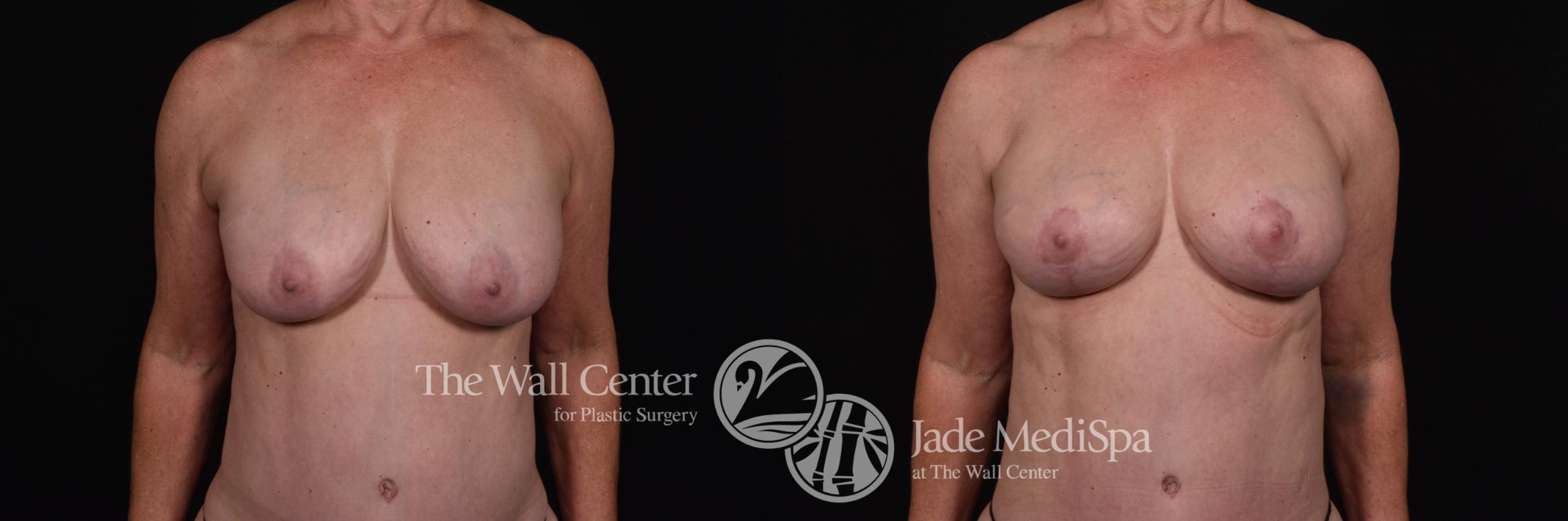 Breast Implant Exchange with Lift & SAFELipo Front Photo, Shreveport, Louisiana, The Wall Center for Plastic Surgery, Case 872