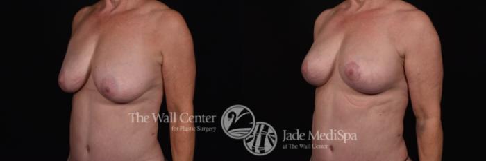 Breast Implant Exchange with Lift & SAFELipo Left Oblique Photo, Shreveport, Louisiana, The Wall Center for Plastic Surgery, Case 872