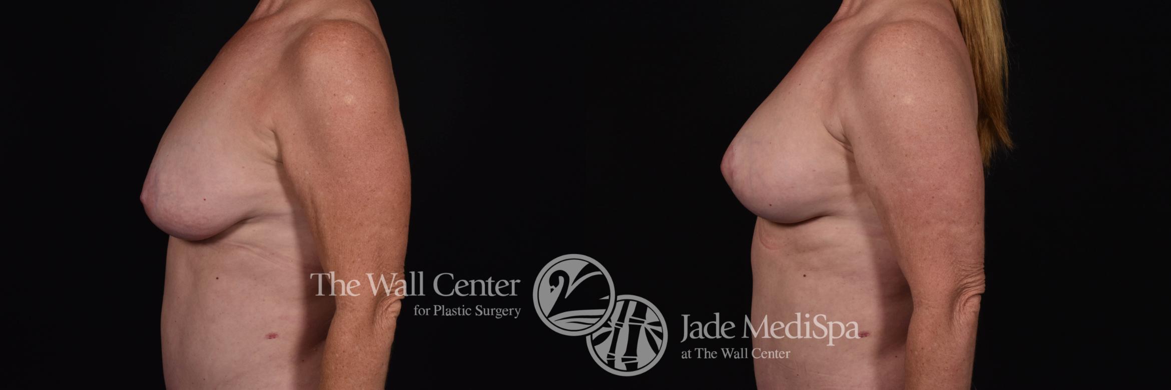 Breast Implant Exchange with Lift & SAFELipo Left Side Photo, Shreveport, Louisiana, The Wall Center for Plastic Surgery, Case 872